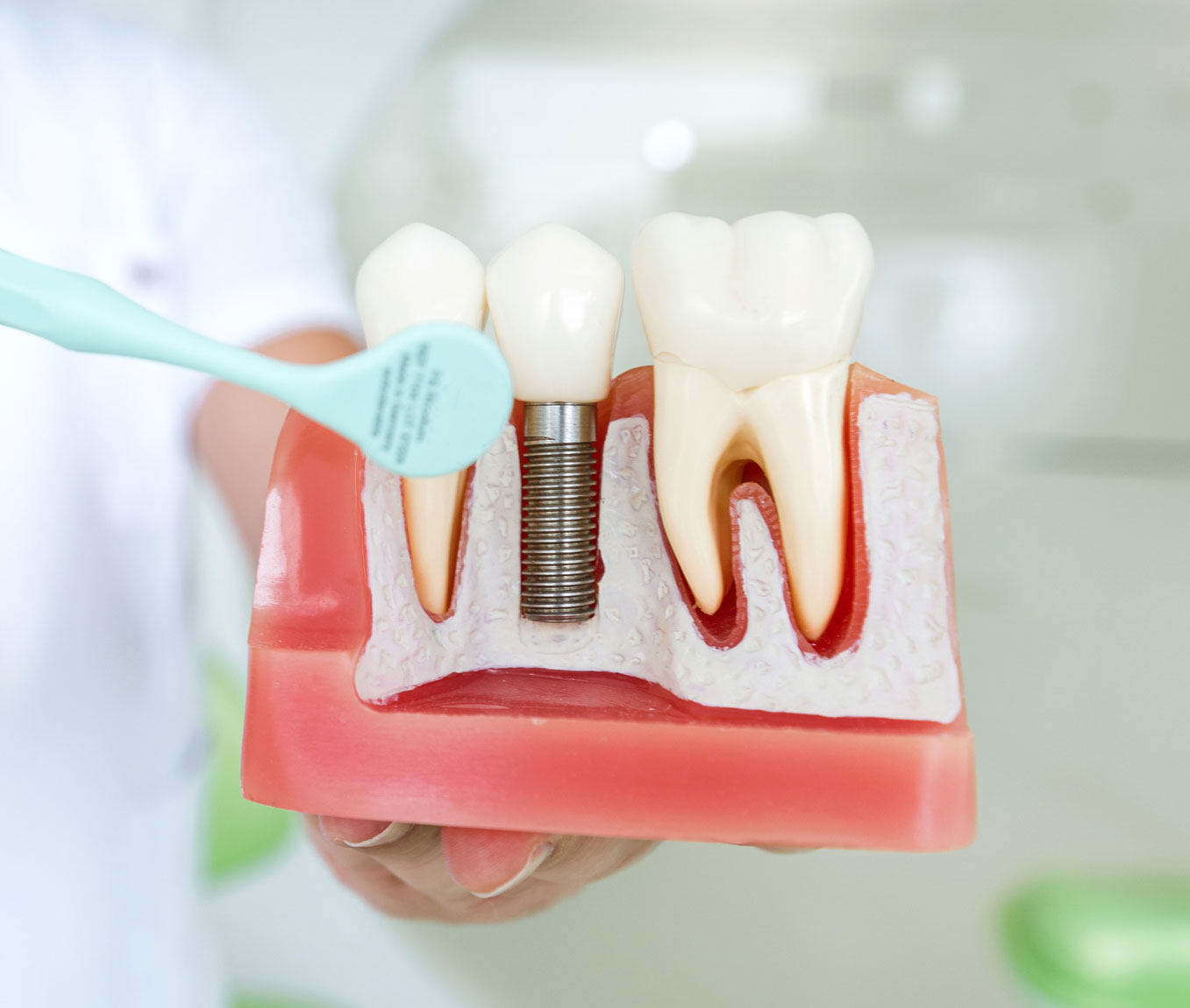 Dental implant modal