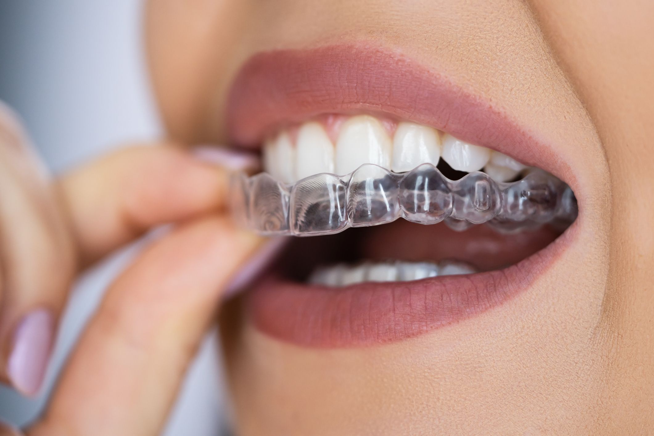 Woman wearing Invisible braces aligner