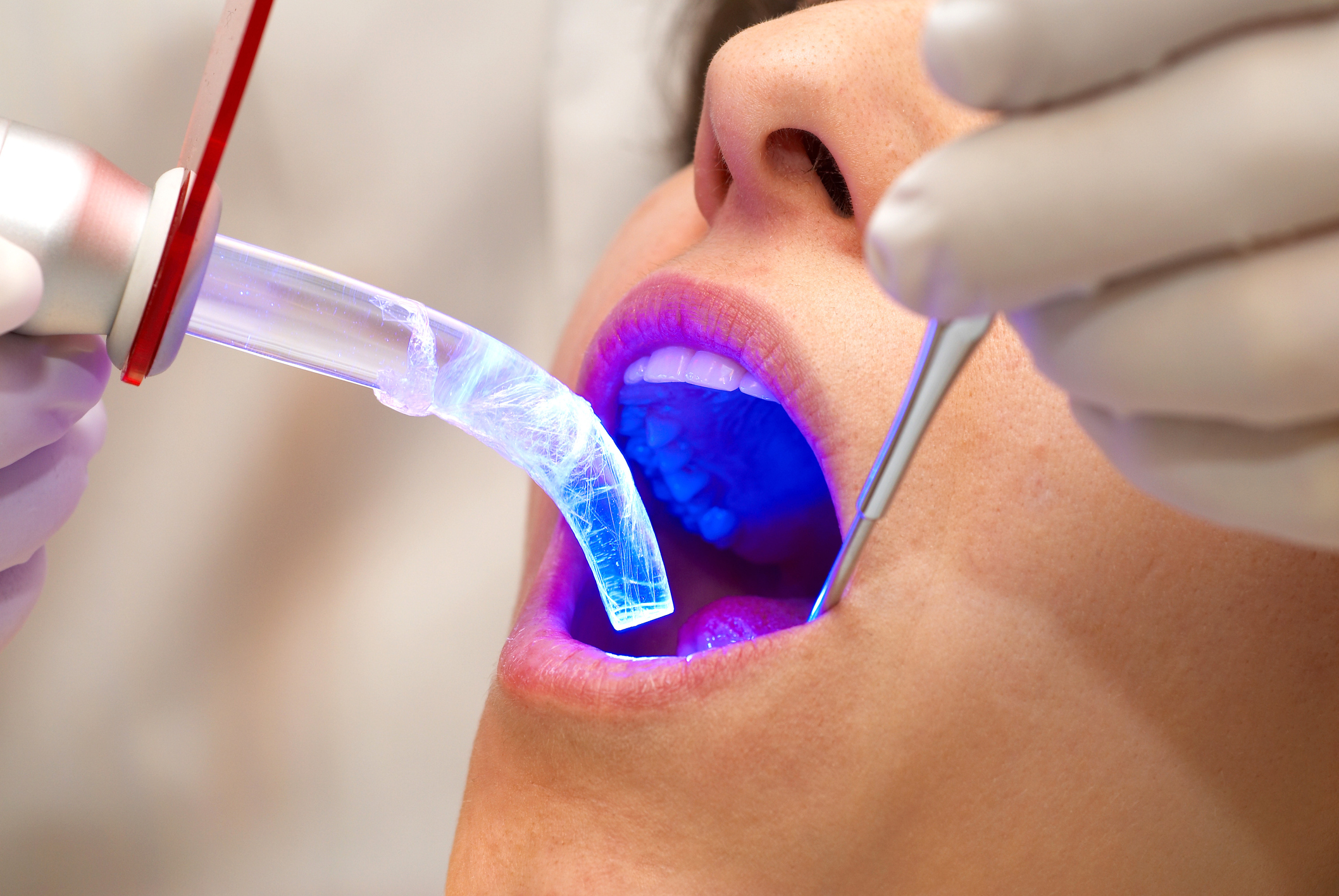 Dentist working with dental polymerization lamp